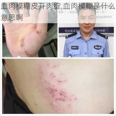 血肉模糊皮开肉绽,血肉模糊是什么意思啊